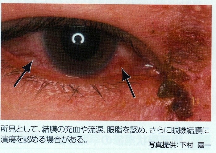 帯状 疱疹 目 の 中