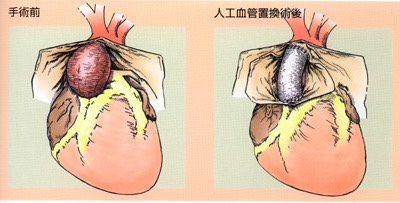 胸部（解離性）大動脈瘤1-squashed